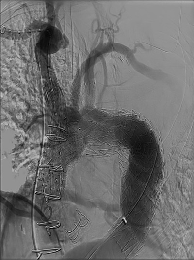 Ross Procedure Total Arch Figure